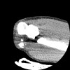 SPORK, NICO - 22.03.1976 - 02.08.2022 - CT obere Extremität - 17:51:17